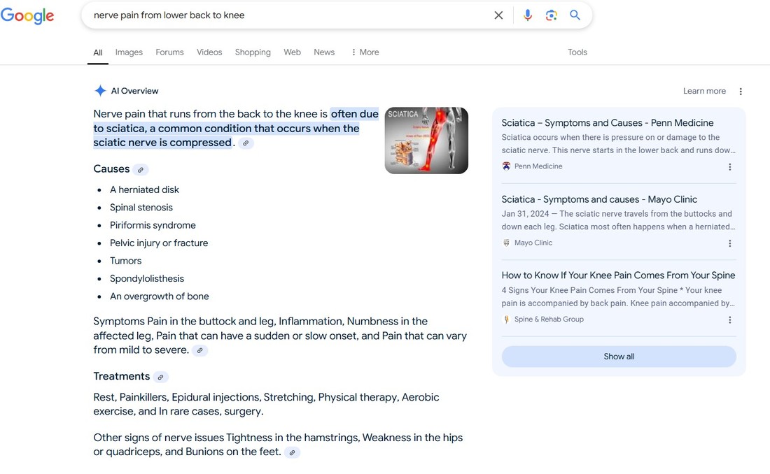 Screenshot of Google search results page for the keyword “nerve pain from lower back to knee,” demonstrating how multimedia stands out in AI Overviews